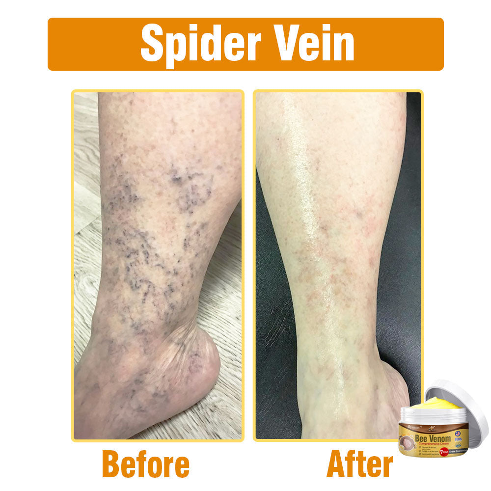 flysmus® Bee Venom Comprehensive Cream