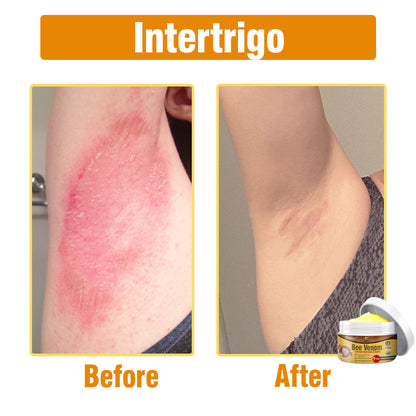 flysmus® Bee Venom Comprehensive Cream