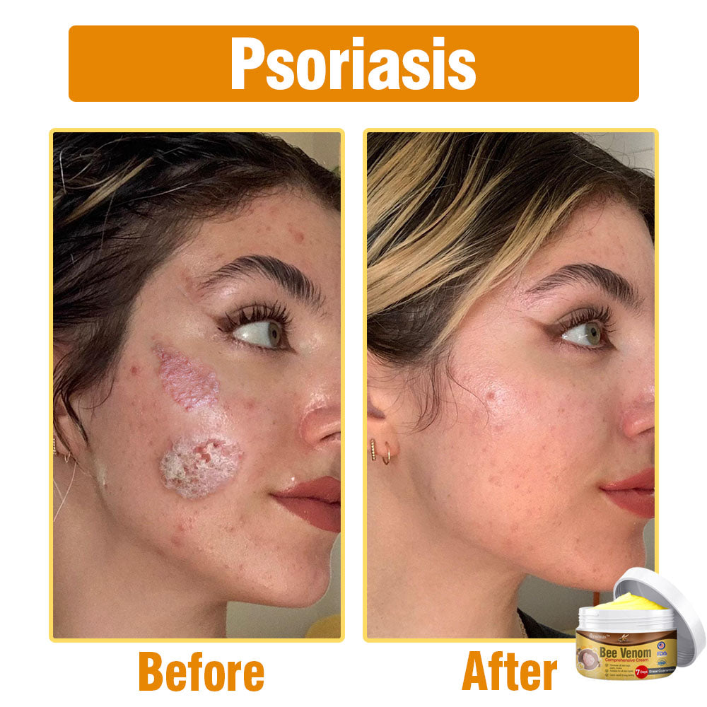 flysmus® Bee Venom Comprehensive Cream