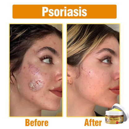 flysmus® Bee Venom Comprehensive Cream