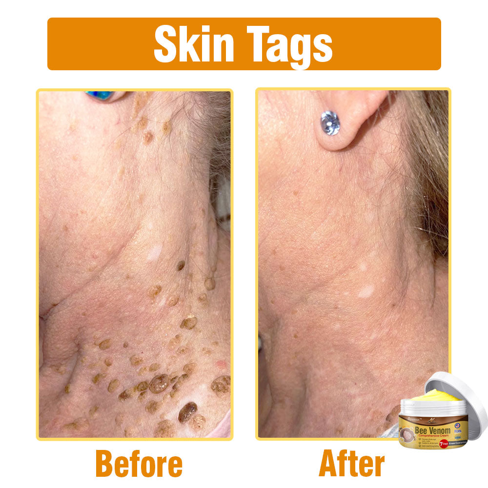 flysmus® Bee Venom Comprehensive Cream