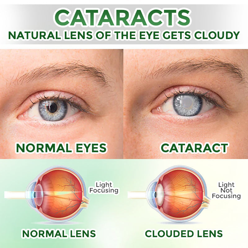 GFOUK® OptiFusion Nano Eye Drops Serum 🇨🇦🩺 Doctor Recommended (for Presbyopia, Cataracts, Glaucoma, Dry Eyes)