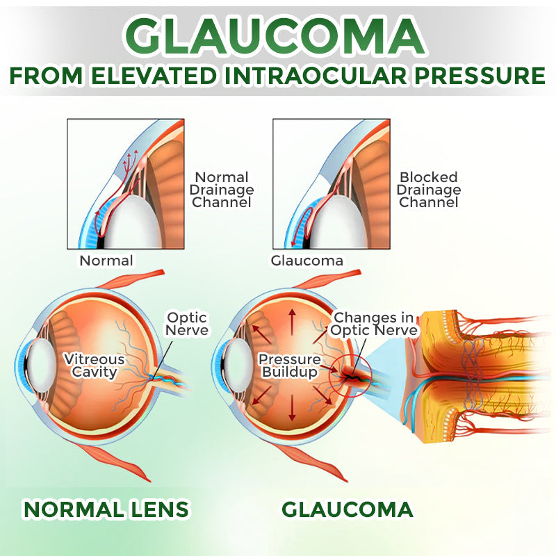 GFOUK® OptiFusion Nano Eye Drops Serum 🇨🇦🩺 Doctor Recommended (for Presbyopia, Cataracts, Glaucoma, Dry Eyes)