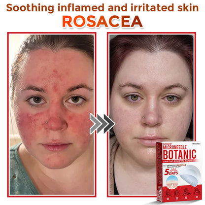 GFOUK® MicroNeedle Botanic Skin Tag Removal Patch 🇨🇦 Made in Canada