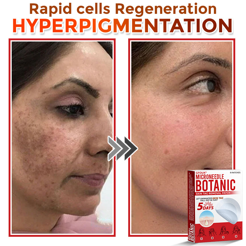 GFOUK® MicroNeedle Botanic Skin Tag Removal Patch 🇨🇦 Made in Canada 🔥